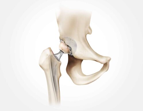 Photomontage aliaspauline prothese hanche dr core agence roughman illustrateur mil pat